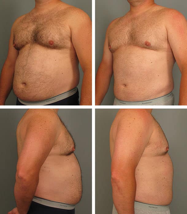 Before and After Image: Liposuction - other