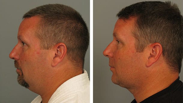 Before and After Image: Liposuction - left-side