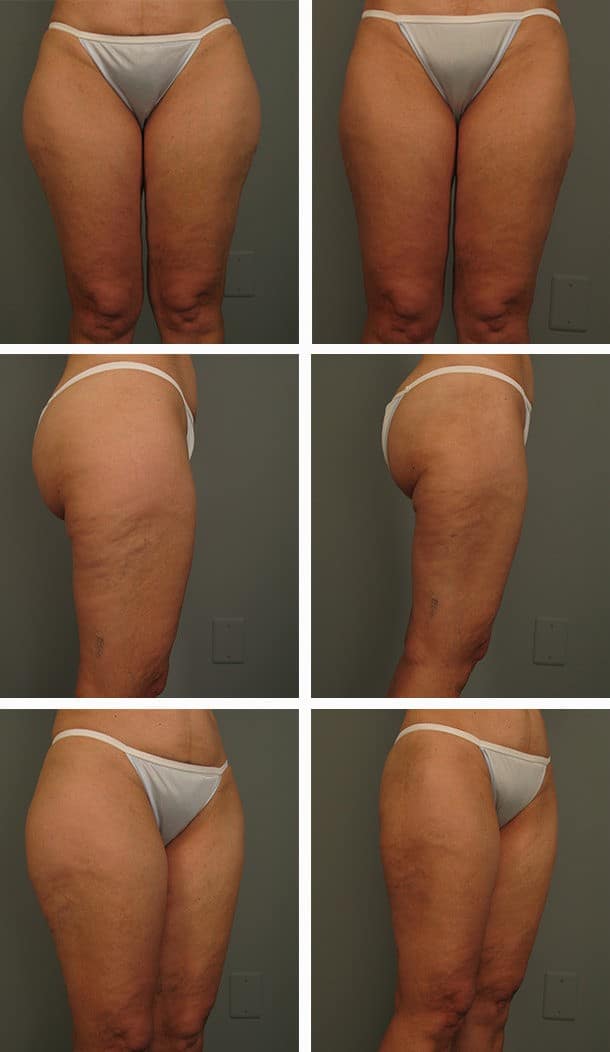 Before and After Image: Liposuction - other