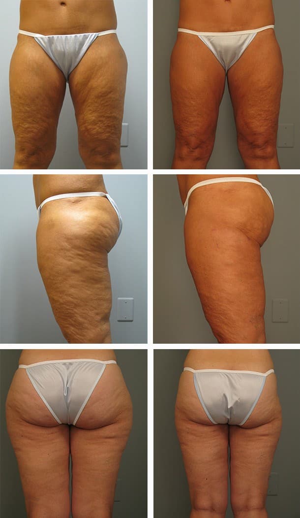 Before and After Image: Liposuction - other