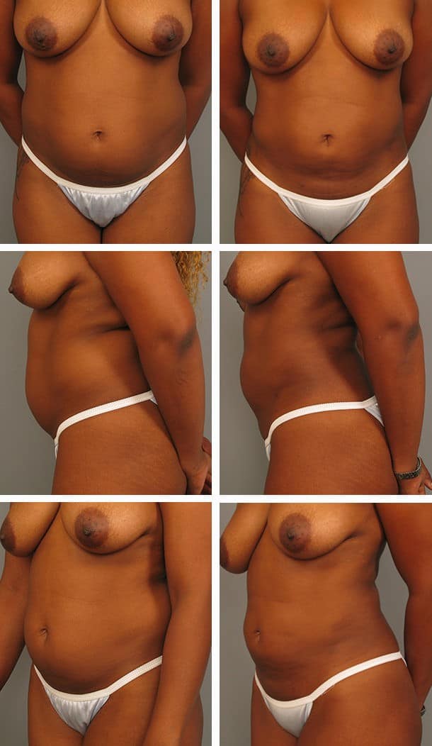 Before and After Image: Liposuction - other