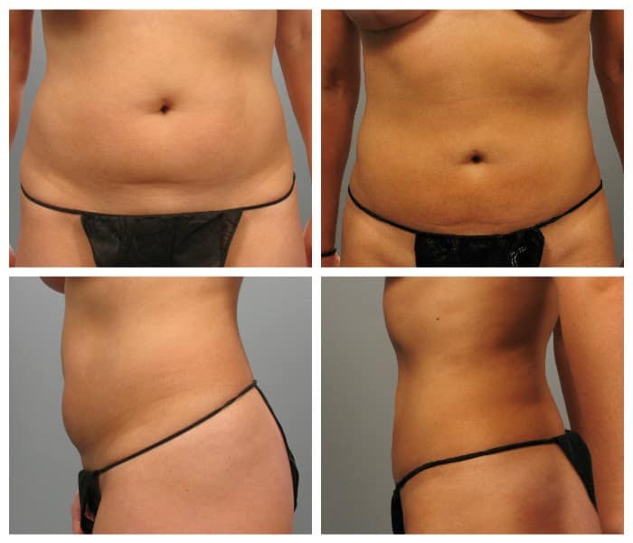 Before and After Image: Liposuction - other