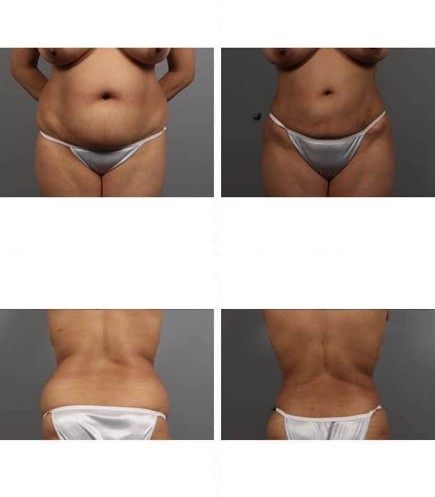 Before and After Image: Liposuction - other