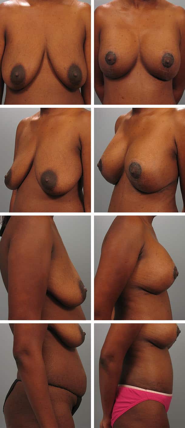 Before and After Image: Mommy Makeover - other