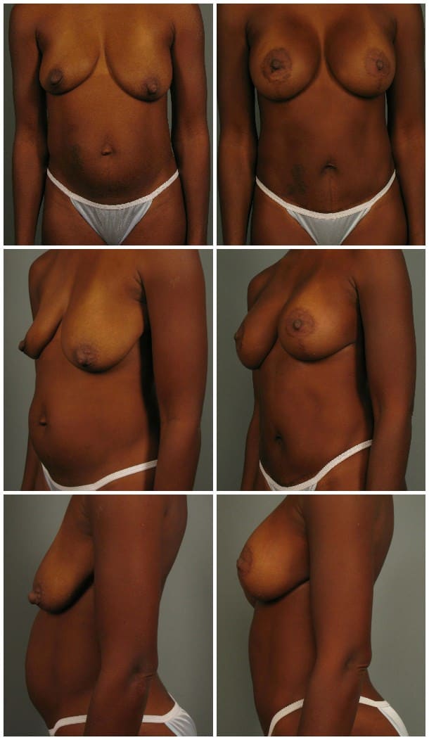 Before and After Image: Mommy Makeover - other