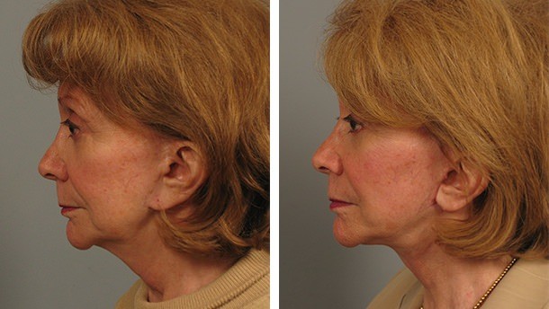 Before and After Image: Necklift - left-side