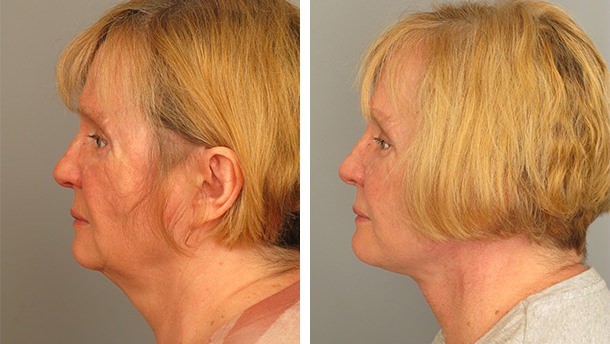 Before and After Image: Necklift - left-side
