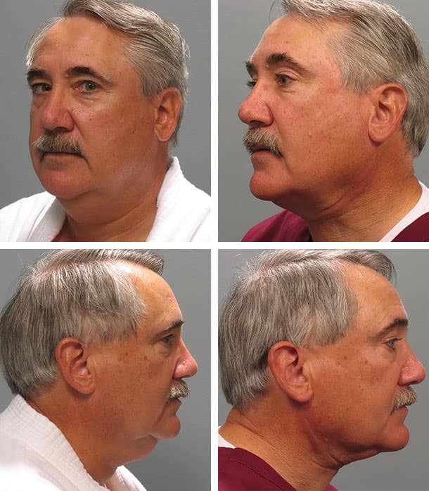 Before and After Image: Necklift - other
