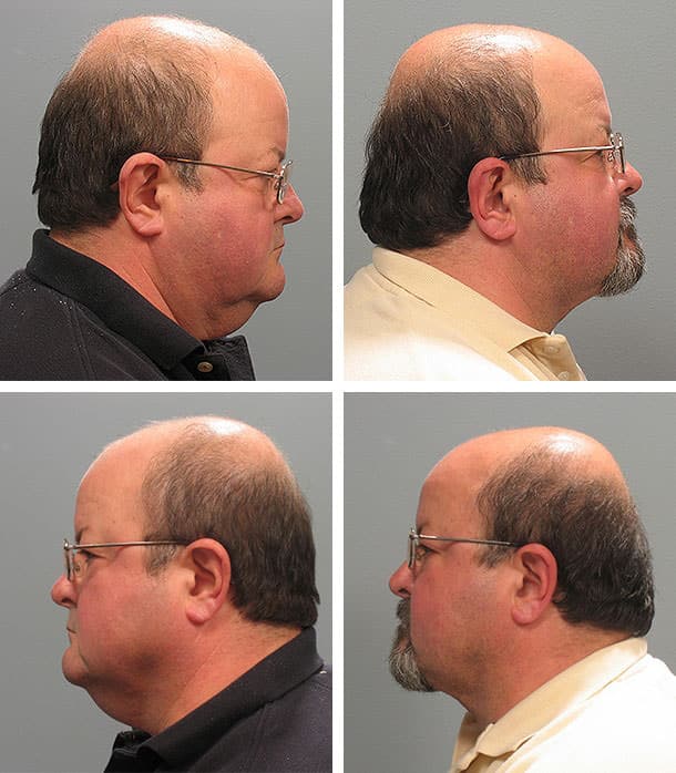 Before and After Image: Necklift - other