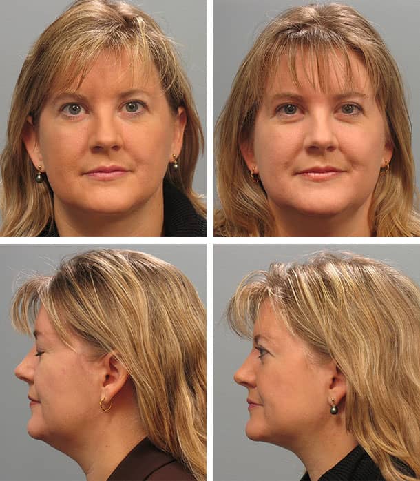 Before and After Image: Necklift - other
