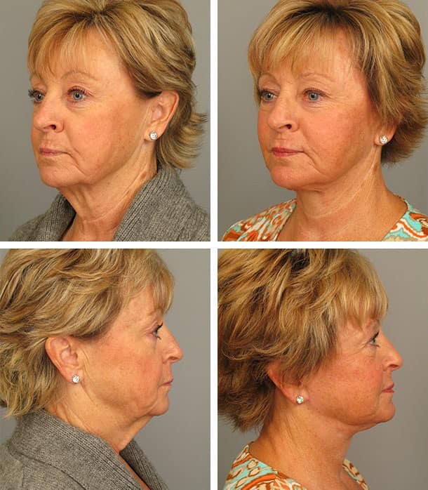 Before and After Image: Necklift - other