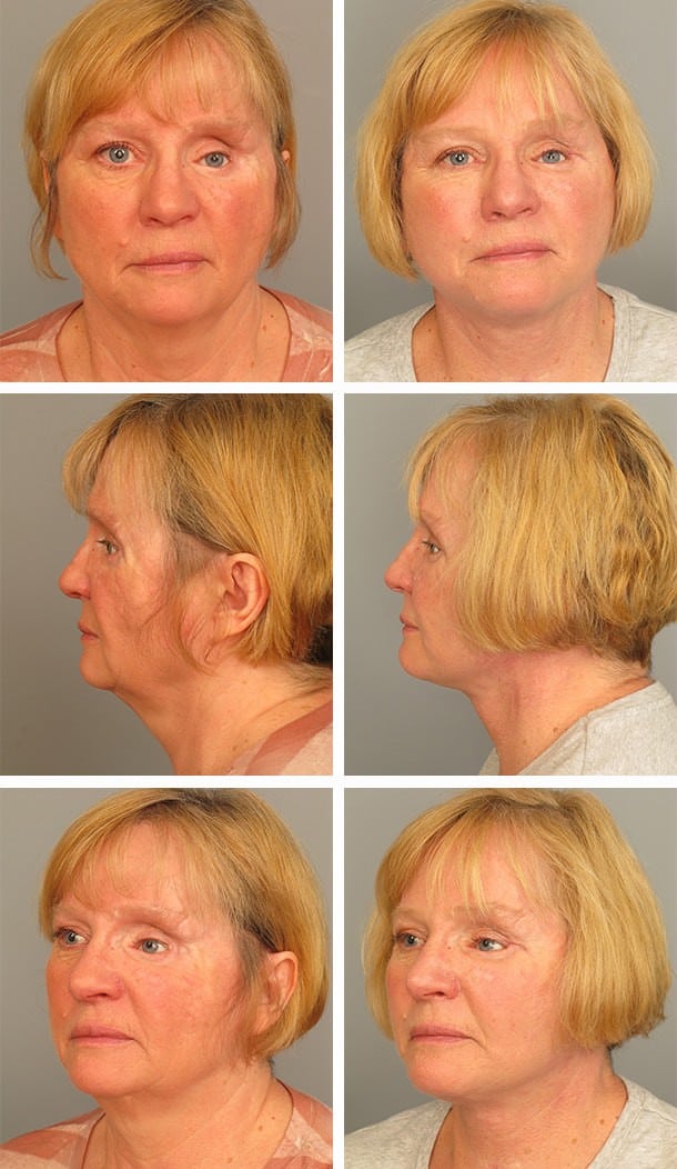 Before and After Image: Necklift - other