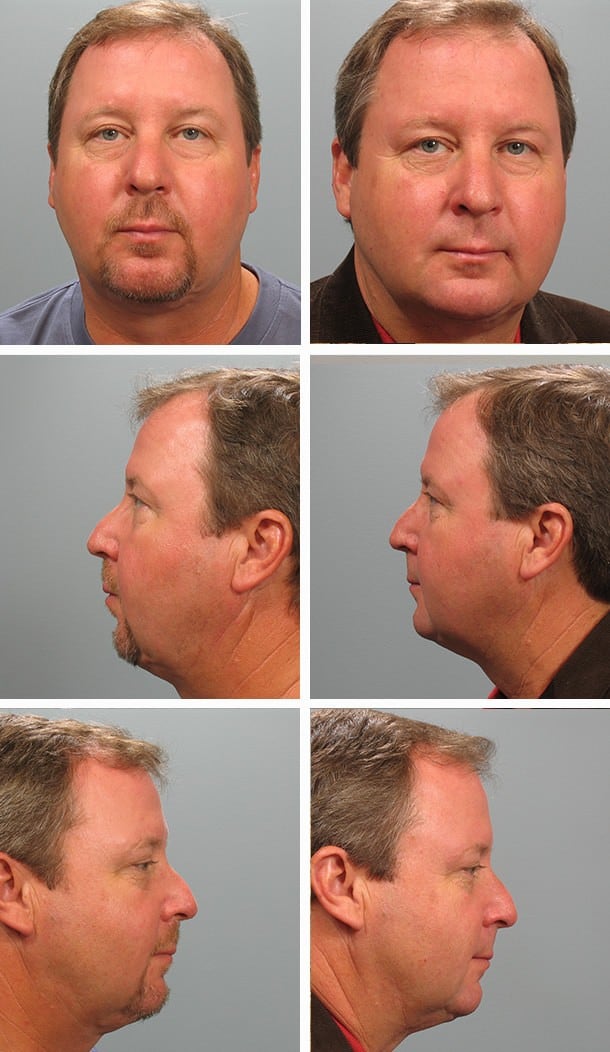 Before and After Image: Necklift - other
