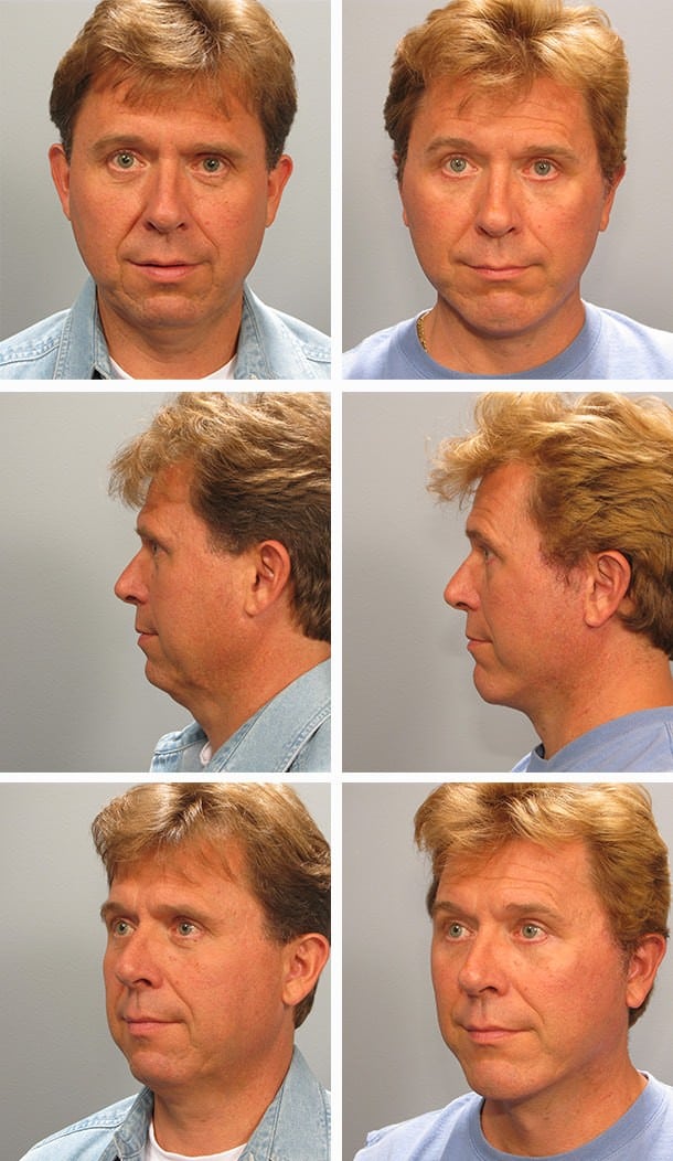 Before and After Image: Necklift - other