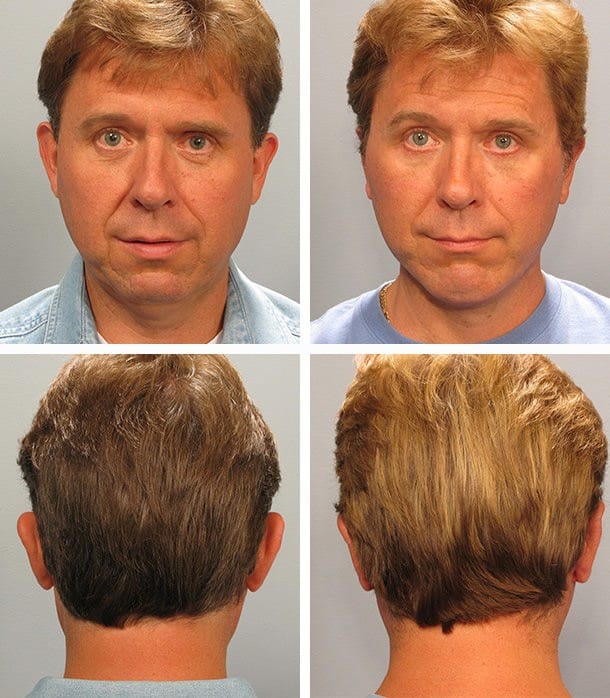 Before and After Image: Otoplasty - other