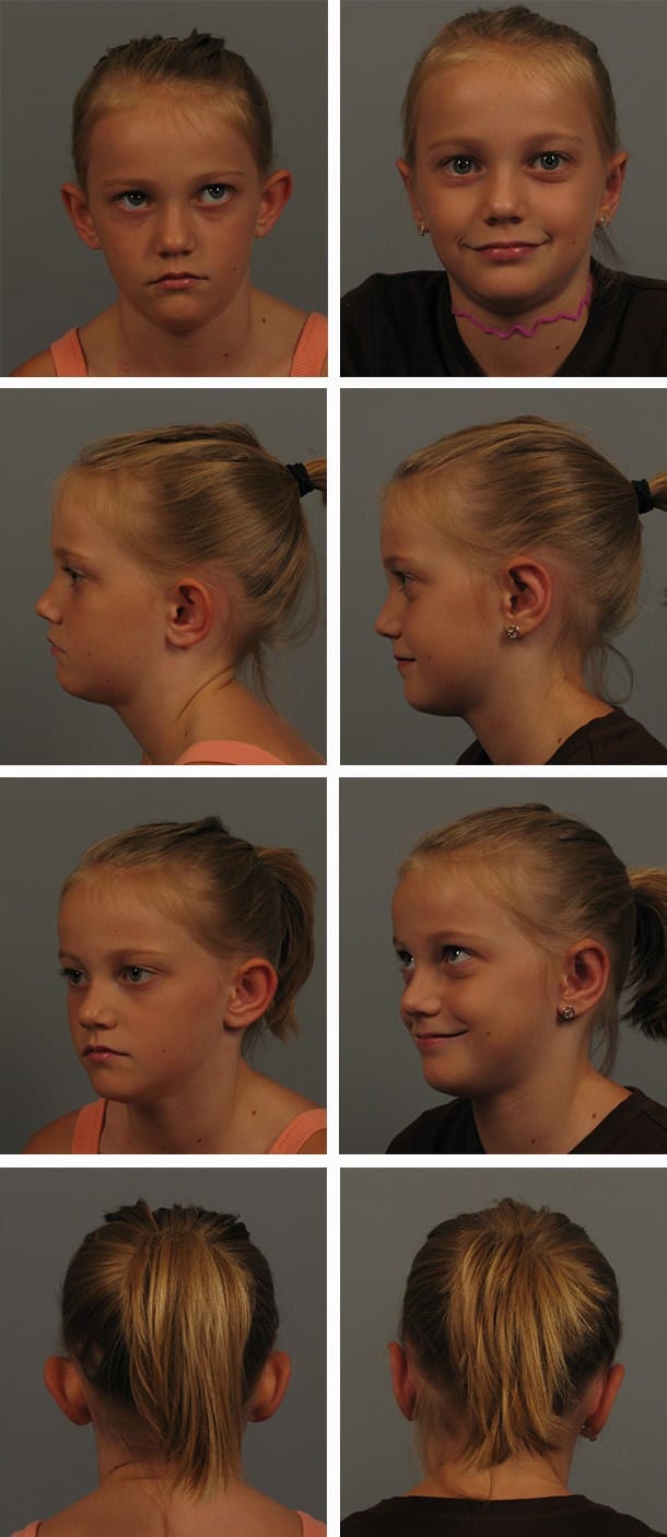 Before and After Image: Otoplasty - other