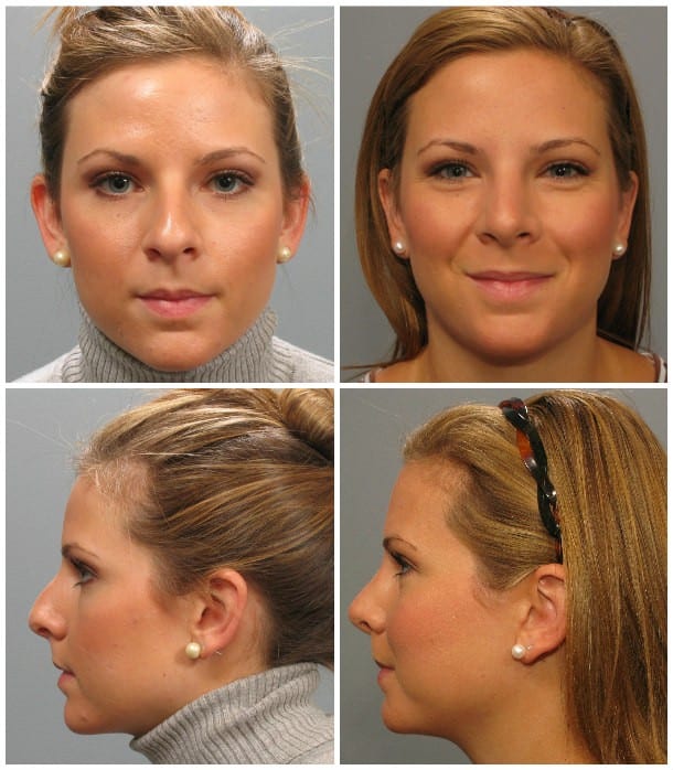 Before and After Image: Otoplasty - other