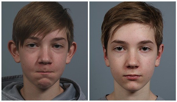 Before and After Image: Otoplasty - front
