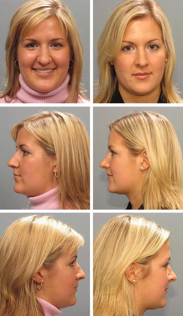 Before and After Image: Rhinoplasty - other