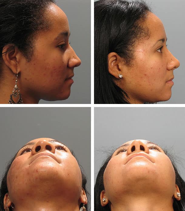 Before and After Image: Rhinoplasty - other