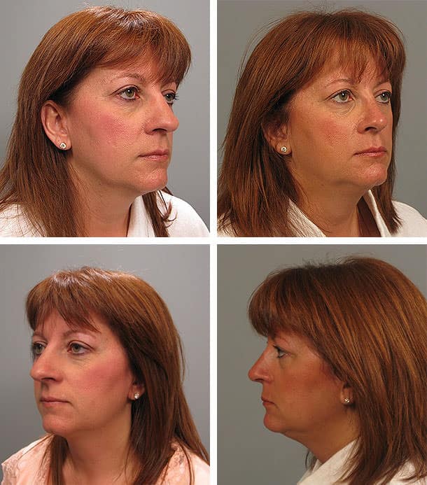 Before and After Image: Rhinoplasty - other