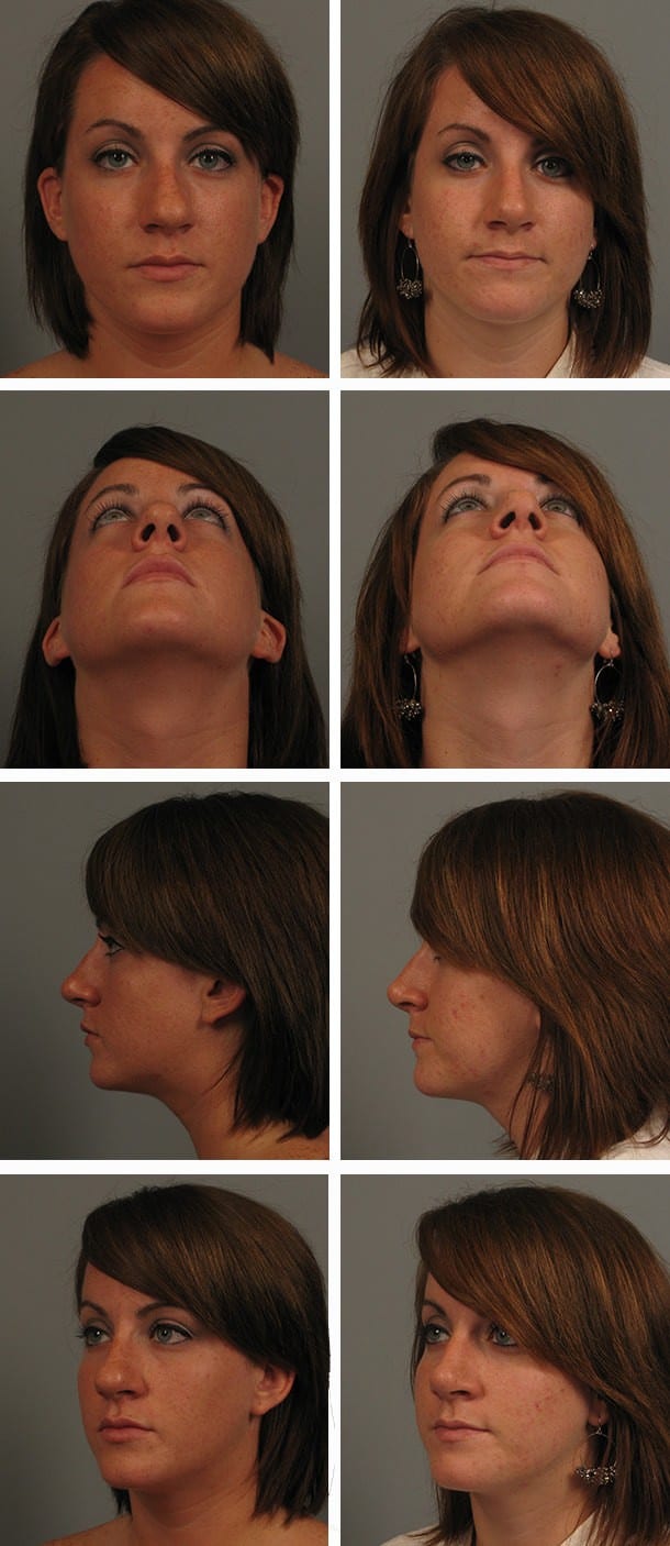 Before and After Image: Rhinoplasty - other