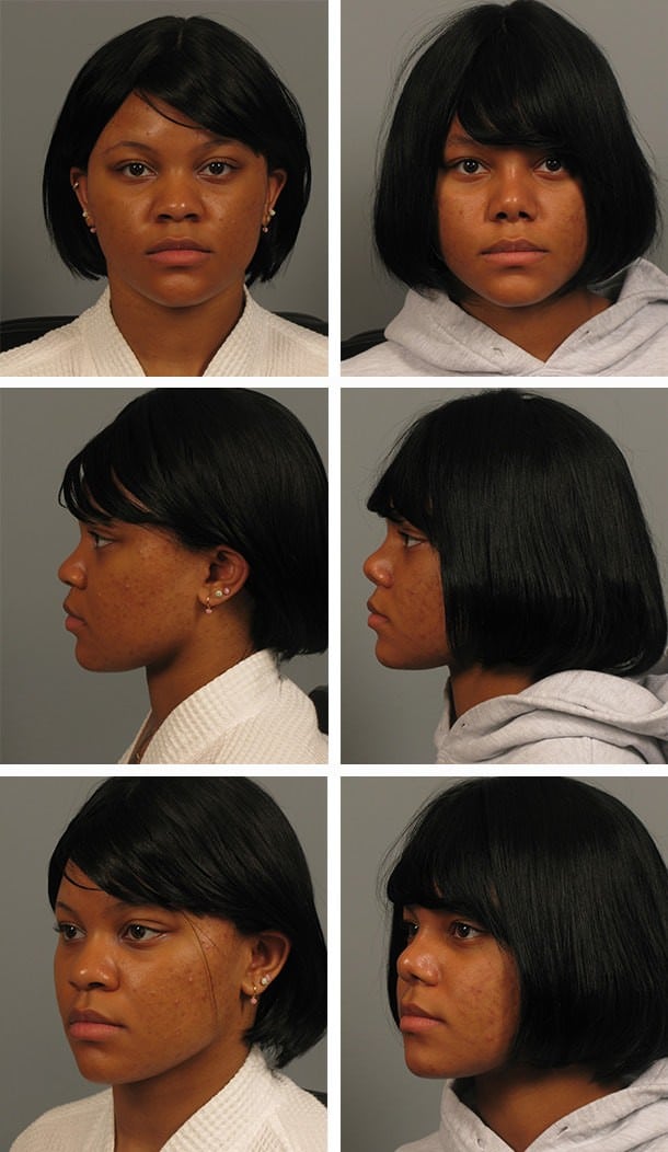 Before and After Image: Rhinoplasty - other