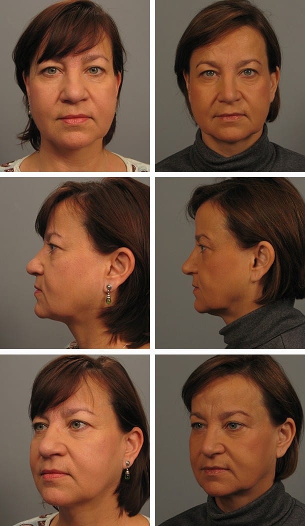 Before and After Image: Rhinoplasty - other