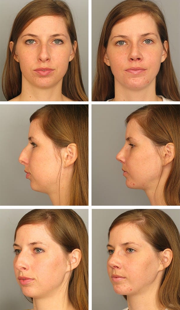 Before and After Image: Rhinoplasty - other