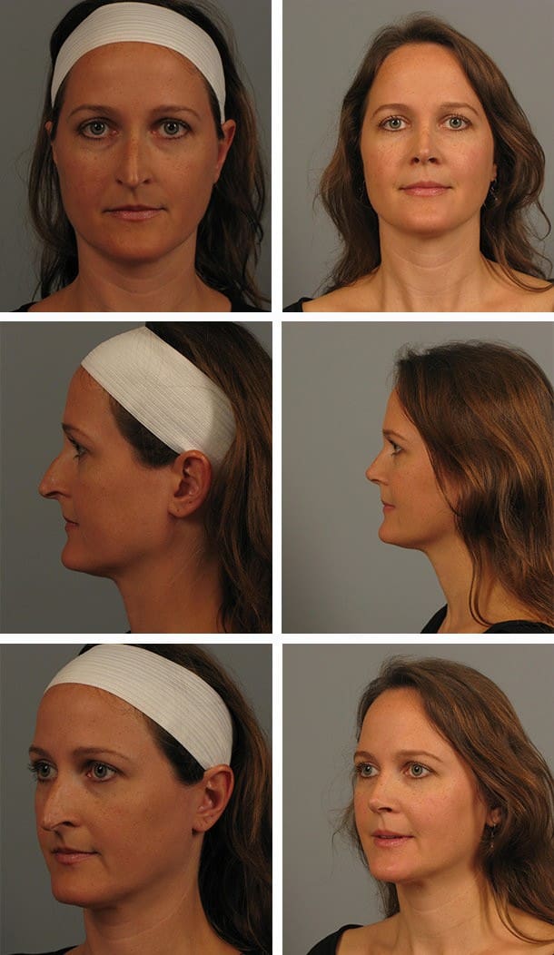 Before and After Image: Rhinoplasty - other
