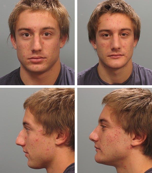 Before and After Image: Rhinoplasty - other