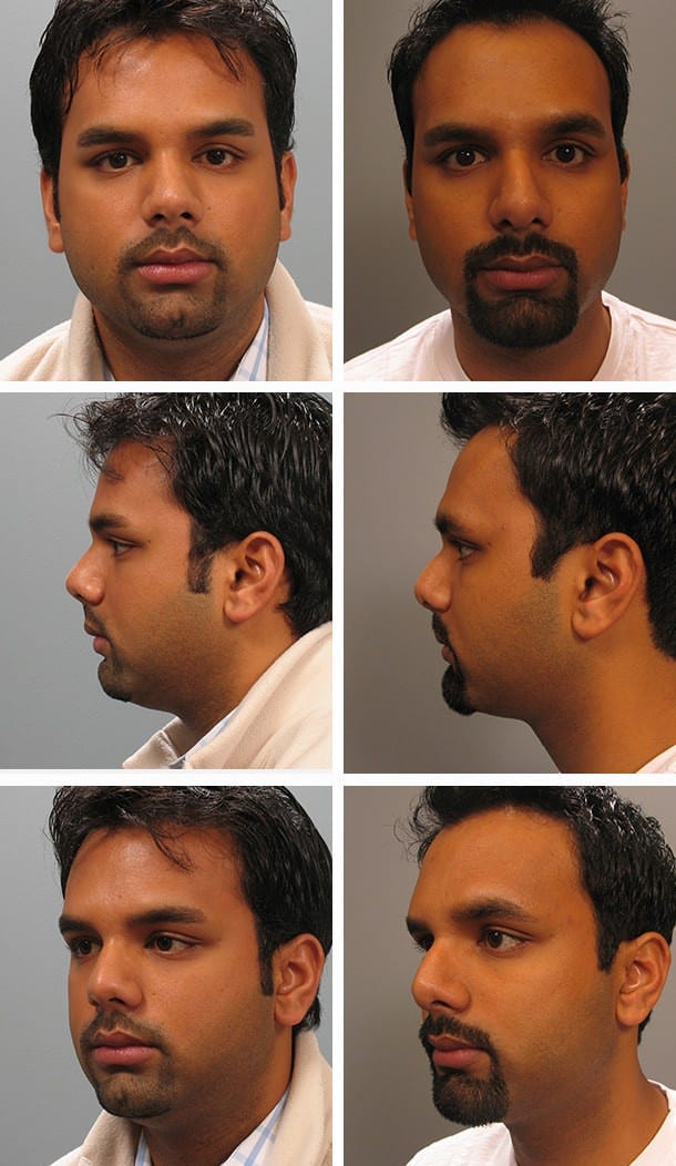 Before and After Image: Rhinoplasty - other