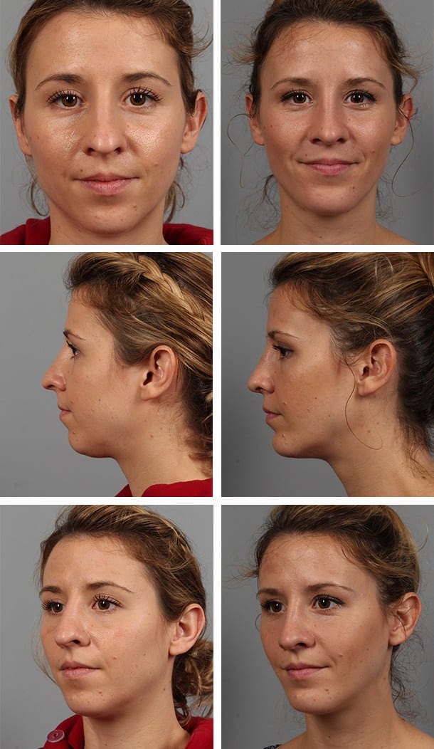 Before and After Image: Rhinoplasty - other
