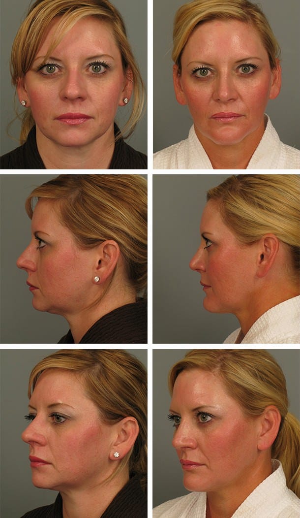 Before and After Image: Rhinoplasty - other