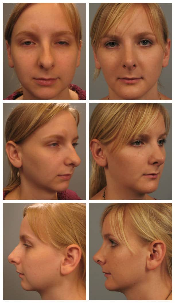 Before and After Image: Rhinoplasty - other