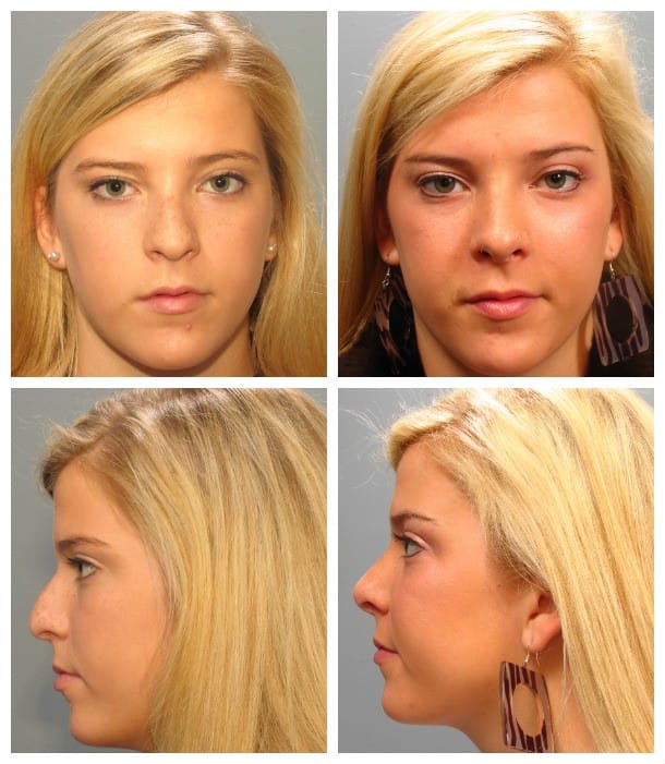 Before and After Image: Rhinoplasty - other