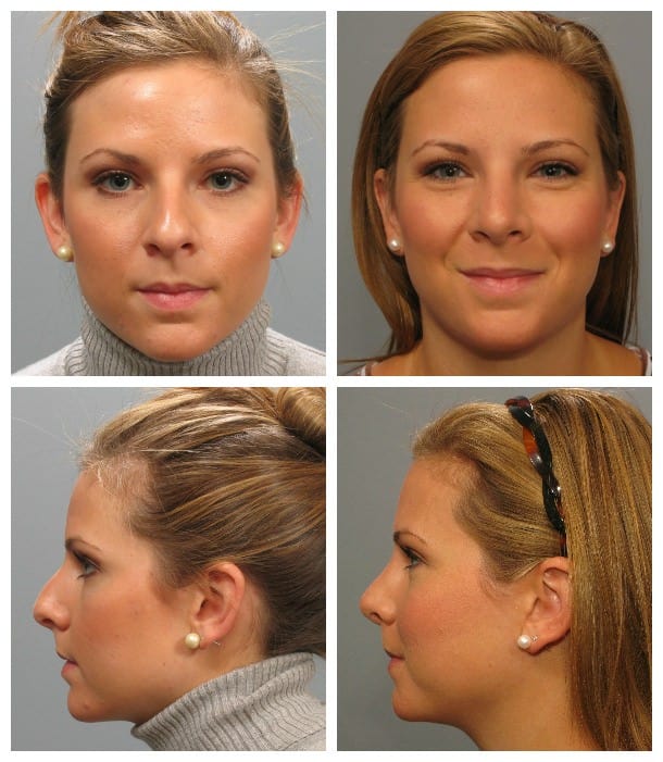 Before and After Image: Rhinoplasty - other