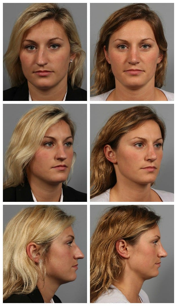 Before and After Image: Rhinoplasty - other