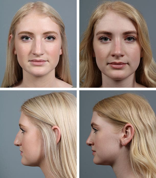 Before and After Image: Rhinoplasty - other