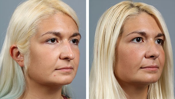Before and After Image: Rhinoplasty - right-front-oblique