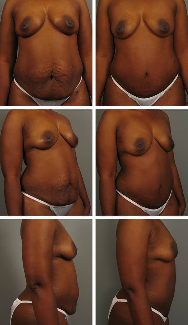 Before and After Image: Tummy Tuck with Liposuction - other