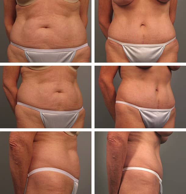 Before and After Image: Tummy Tuck with Liposuction - other