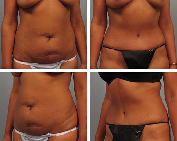 Before and After Image: Tummy Tuck with Liposuction - other