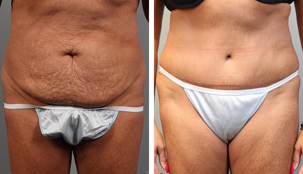Before and After Image: Tummy Tuck with Liposuction - front