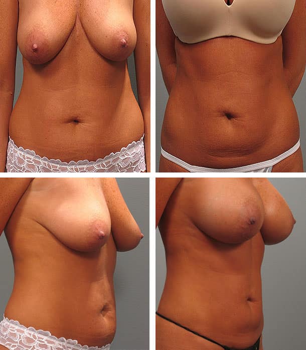 Before and After Image: Tummy Tuck with Liposuction - other