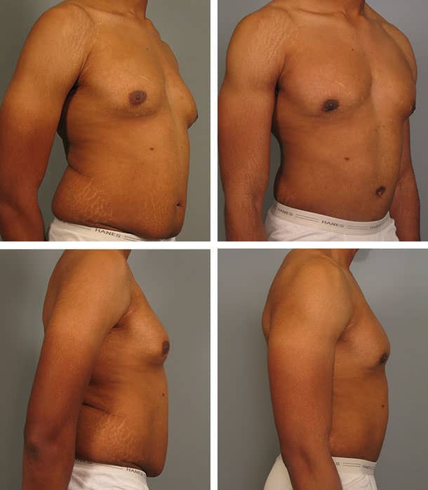 Before and After Image: Tummy Tuck with Liposuction - other