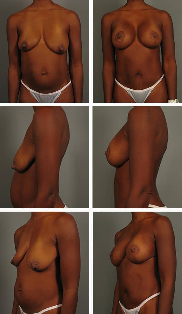 Before and After Image: Tummy Tuck with Liposuction - other
