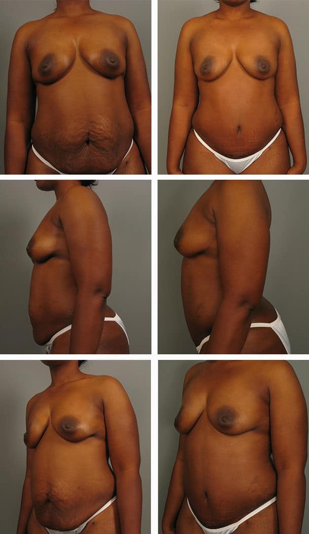 Before and After Image: Tummy Tuck with Liposuction - other