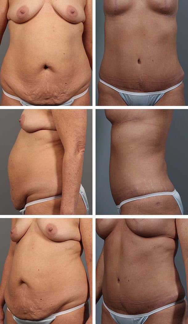 Before and After Image: Tummy Tuck with Liposuction - other