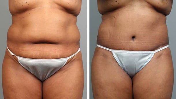 Before and After Image: Tummy Tuck with Liposuction - front